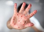 Wabah Campak Tewaskan 50 Anak di Samoa