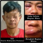 DIHAJAR Hingga Bengkak di Bagian Mulut dan Lebam Di Mata